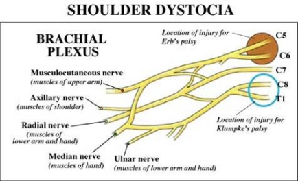 shoulder dystocia brachial plexus injury
